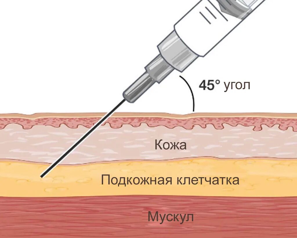 Подкожная инъекция. Подкожная и внутрикожная инъекция. Угол введения иглы при подкожной инъекции. Подкожный укол. Как колоть железо внутримышечно