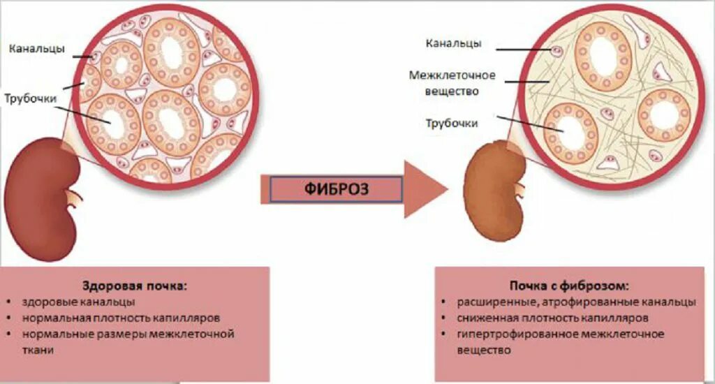 Фиброз паренхимы почек. Первичное сморщивание почки. Почка при хроническом пиелонефрите. Симптомы фиброза у мужчин