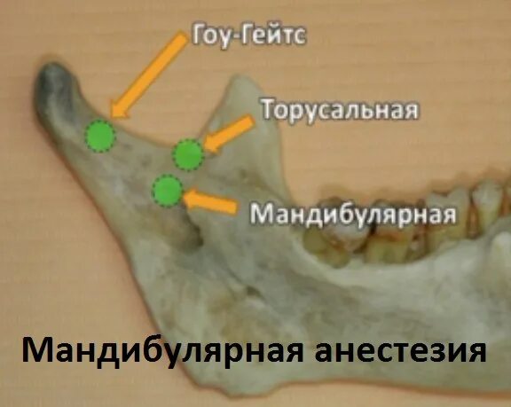 Анестезия по гейтсу. Проводниковая анестезия мандибулярная. Внутриротовая мандибулярная анестезия. Мандибулярная анестезия методика. Проводниковая анестезия торусальная.