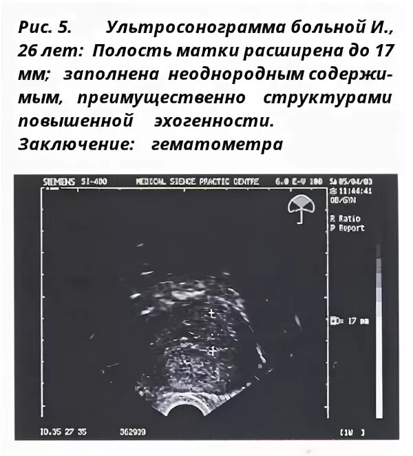 Гематометра симптомы. Узи признаки гематометры. гематометра узи картина. заключение узи гематометра.
