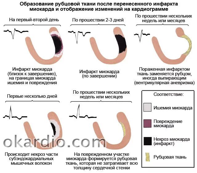 Формирование рубца после инфаркта. Инфаркт миокарда после стентирования. Инфаркт миокарда рубец.