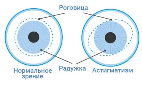 Зрение астигматизм как видит человек