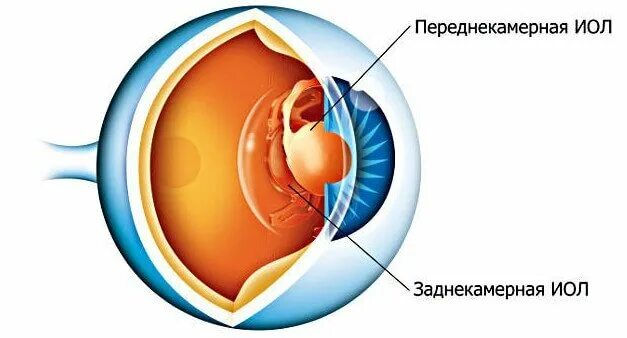 Артифакия глаза после замены хрусталика что такое. Тринитротолуоловая катаракта. Имплантация факичных иол. Имплантация факичных иол. Артифакия мкб 10.
