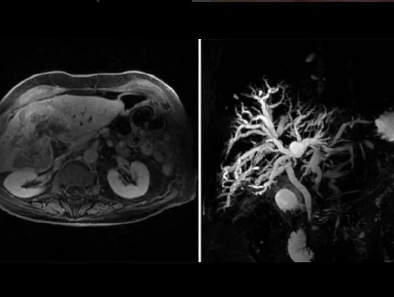 Магнитно-резонансная холангиография желчного пузыря. Холангиография желчного пузыря.