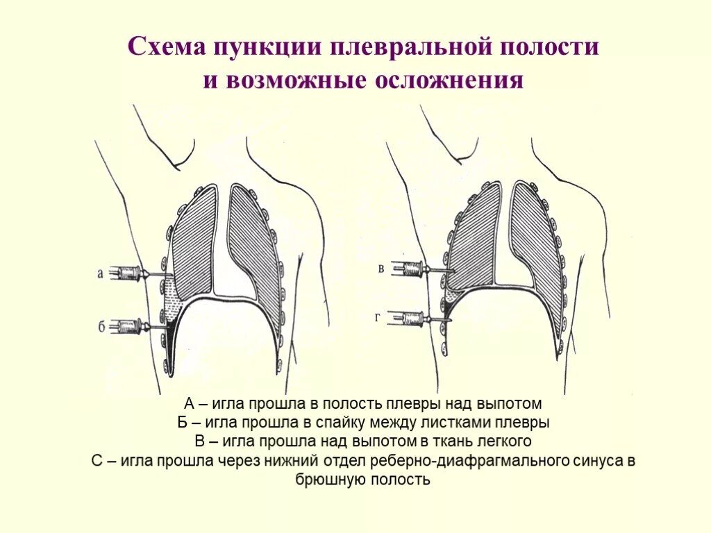 Полость страдать. Пункция плевральной полости схема. Пункция плевральной полости при гидротораксе техника. Плевральная пункция пневмоторакс схема. Точки пункции плевральной полости при пневмотораксе и гидротораксе.