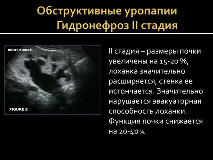 Гидронефротическая трансформация почки