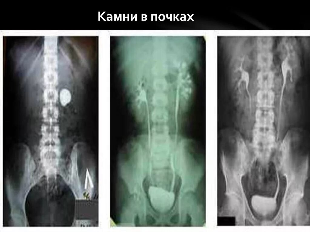 Боли после выхода камня