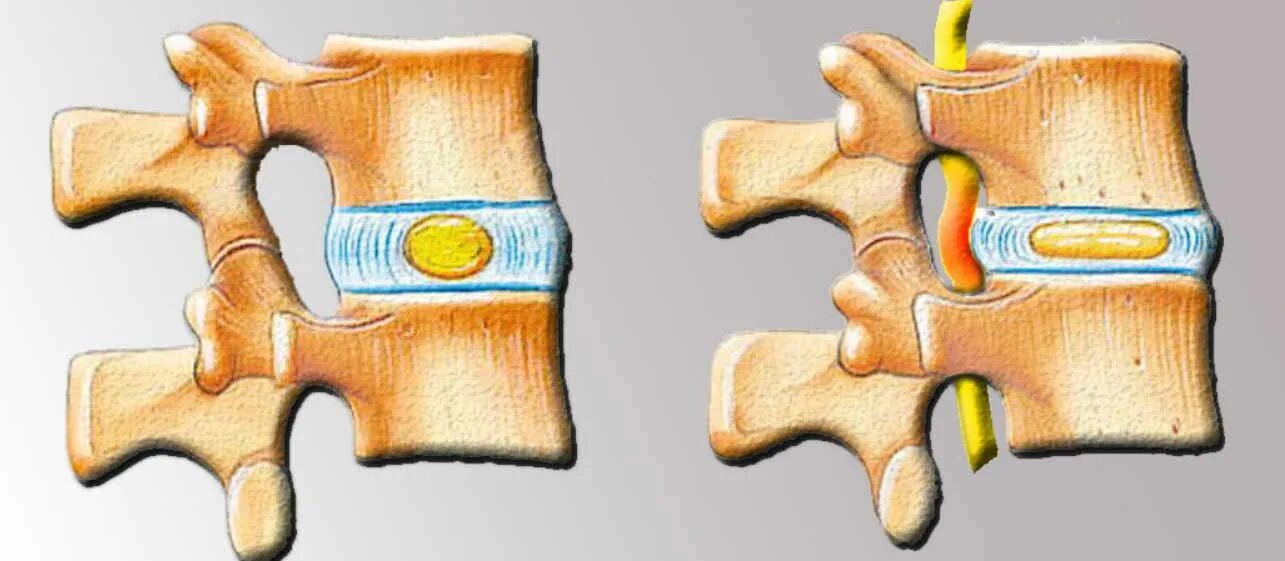 3 4 5 межпозвоночного диска. Межпозвонковый диск. Строение межпозвоночного диска. Межпозвоночная грыжа. Диски позвоночника.