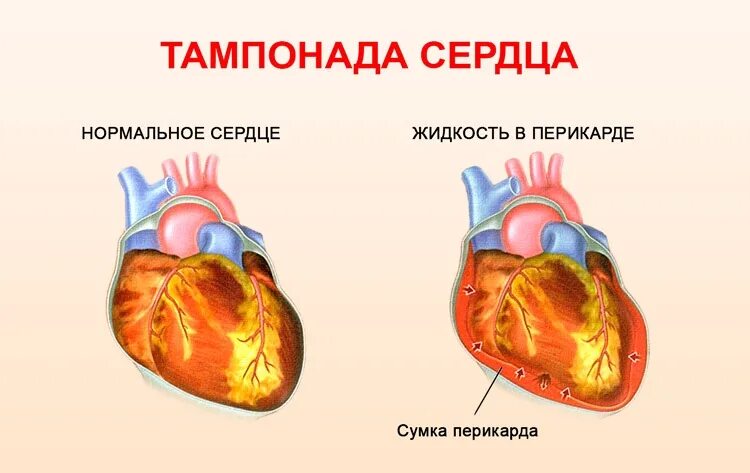 Слепое сердце это. Перикардит с тампонадой сердца симптомы. Гидроперикард тампонада сердца. Тампонада полости перикарда. Острая тампонада сердца.