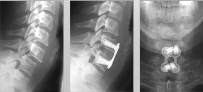 Остеосинтез позвоночника пластиной. Гипермобильность с4 с5 сегмента шейного отдела позвоночника. Нестабильность с2-с4. Нестабильность сегментов с3-с6. Операция смещение позвоночника