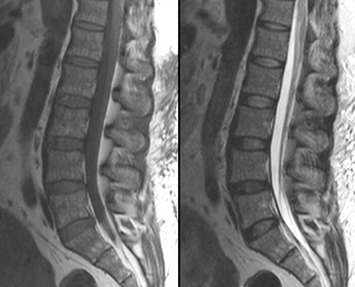 Spine mri. Mri spine t1 t2. мрт l-spine. lumbar spine mri. normal mri thorax spine.
