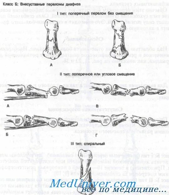 Перелом фаланги мкб 10. Классификация переломов фаланг пальцев кисти. Перелом диафиза средней фаланги. Перелом концевой фаланги.