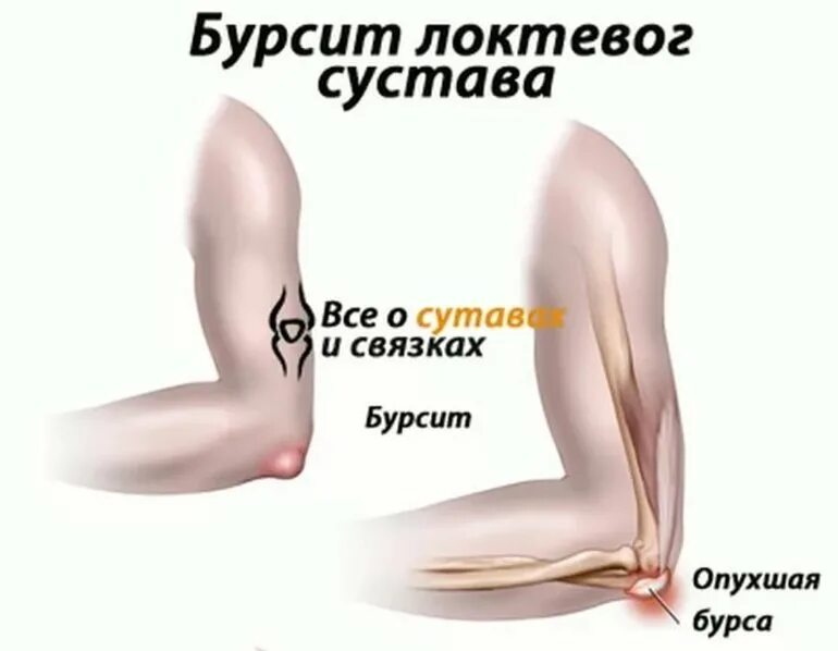 Бурсит коленного сустава карта вызова