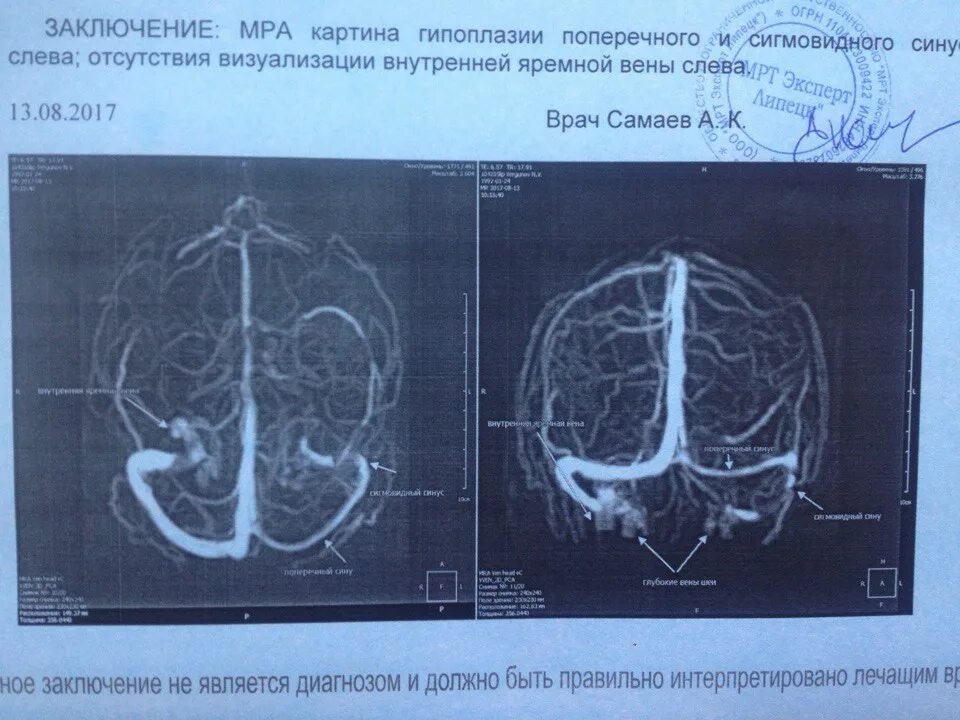 Гипоплазия левого поперечного синуса. Мрт. Тромбоз левого сигмовидного синуса мрт головного мозга. Гипоплазия левого поперечного синуса головного мозга на мрт. Асимметрия поперечного синуса мрт. Гипоплазия правых синусов