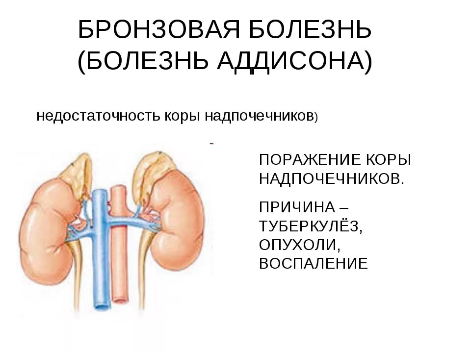 Заболевание надпочечников симптомы и признаки. Недостаточность функции надпочечников. Болезнь Аддисона патогенез схема. Недостаточность надпочечников болезнь Аддисона. Аддисонова (бронзовая) болезнь.