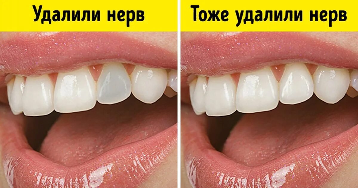 Удалили зубы чем заменить