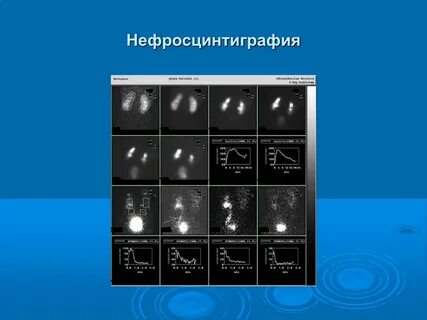Нефросцинтиграфия почек в москве