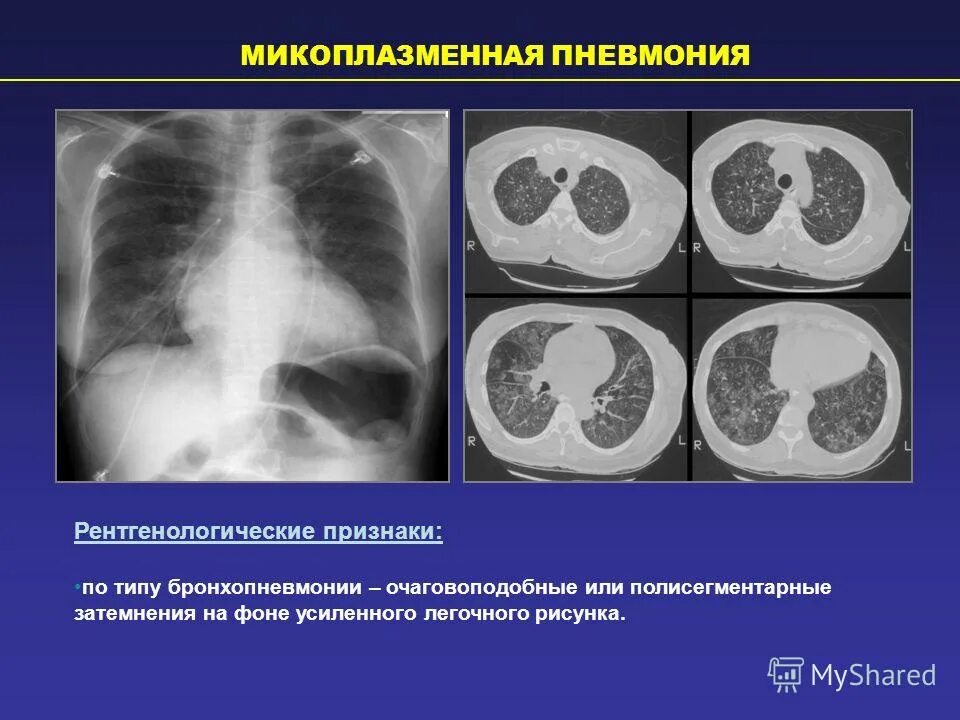 лечение микоплазменной пневмонии. что такое микроплазменная пневмония. клинические особенности микоплазменной пневмонии. внебольничная пневмония микоплазменная. для микоплазменной пневмонии характерно.