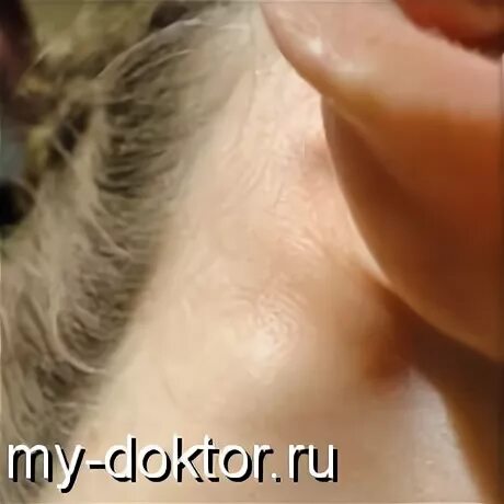 Увеличен лимфоузел за ухом после коклюша - Вопрос педиатру - 03 Онлайн