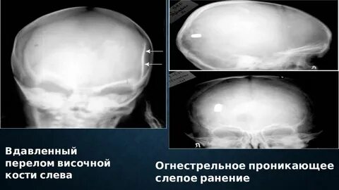 Перелом основной кости