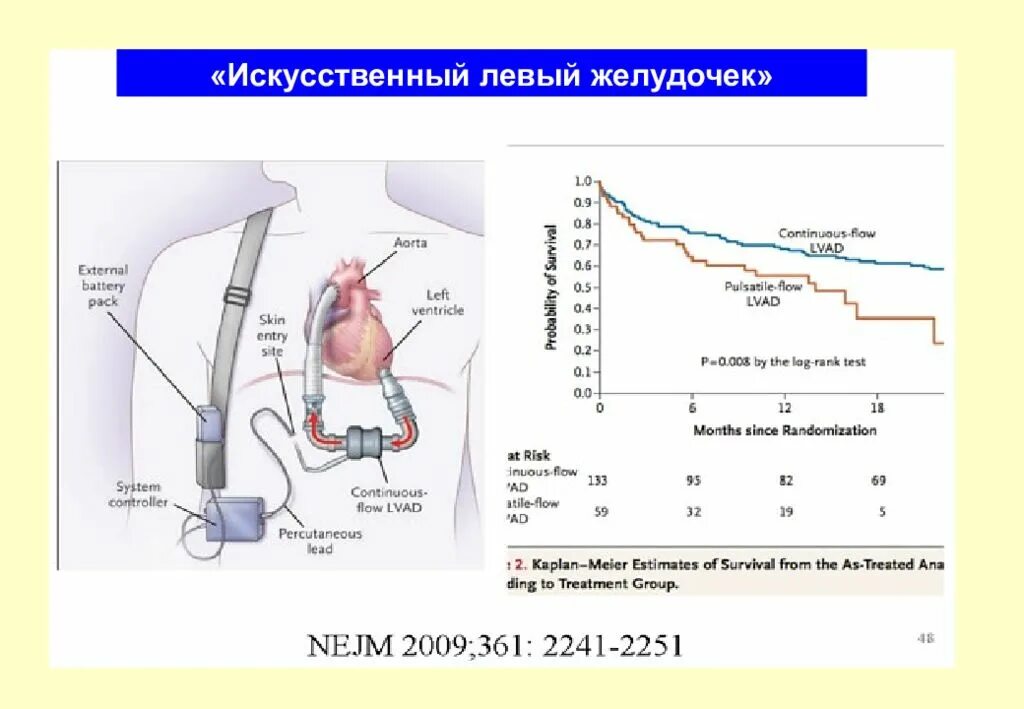 Искусственного левого желудочка (LVAD). Имплантация искусственного левого желудочка. Искусственный механический желудочек сердца. Вспомогательный левый желудочек.