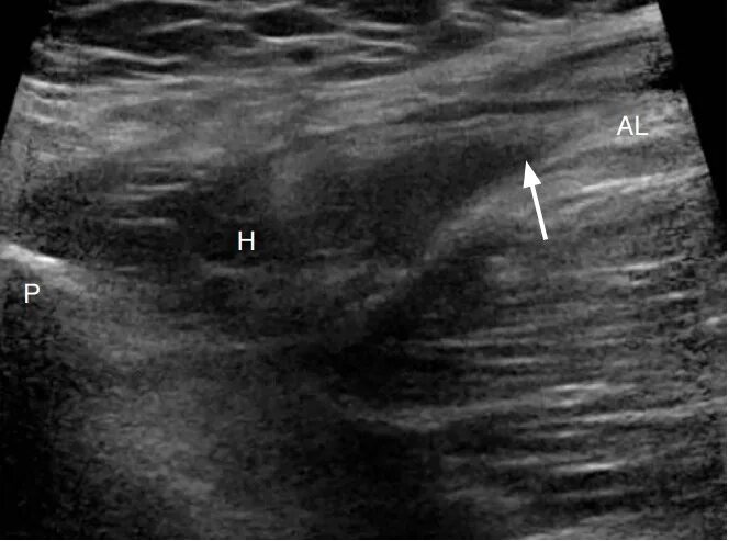 Разрыв икроножной мышцы узи. Узи картина гематомы мышцы. Липома мягких тканей на узи. Узи мышц что показывает. Узи кивательной мышцы протокол.