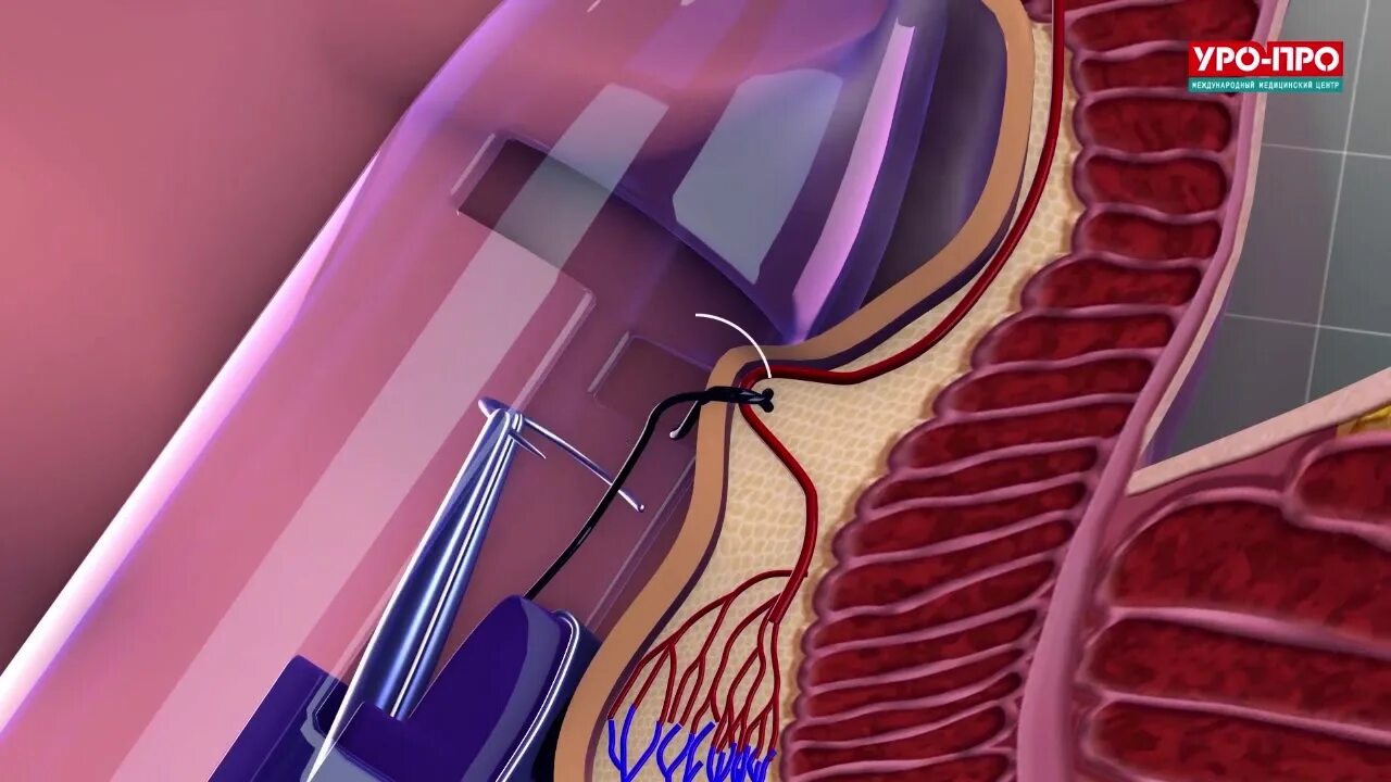 Hal-rar дезартеризация геморроидальных узлов. Дезартеризация геморроидальных узлов аппаратом hal-Doppler. Трансанальная дезартеризация.