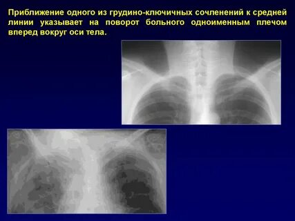 Рентген грудино ключичного сочленения
