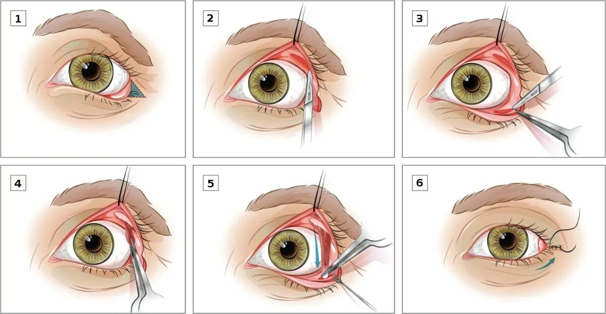 Энуклеация глазного яблока. Коньюктивита блефаропластика нижних век. Попала ворсинка в нлаз. Инородное тело конъюнктивы. Нависание верхнего века.