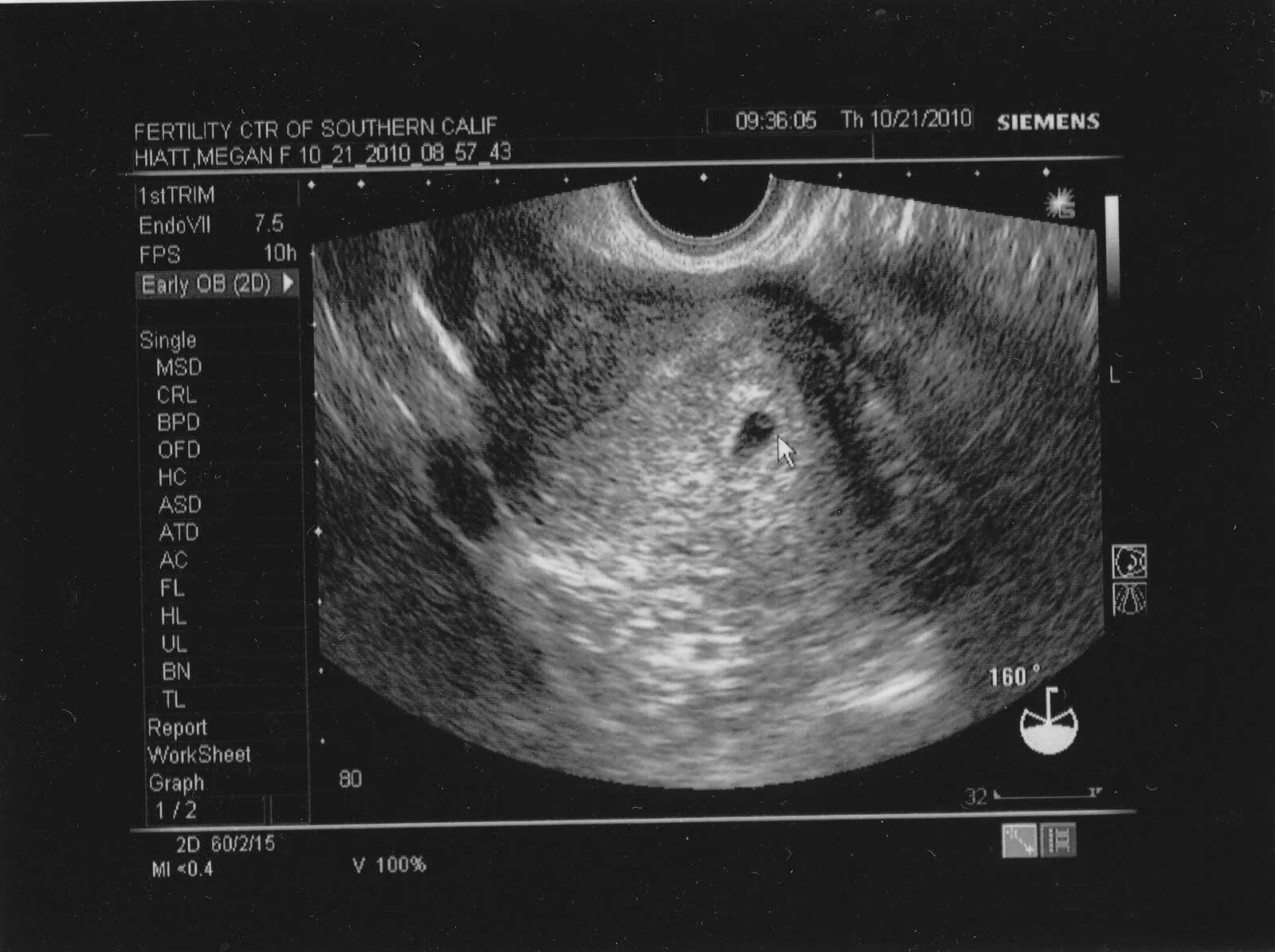 Эмбрион на 2 неделе беременности. Как выглядит эмбрион в 5 недель на УЗИ. Эмбрион на 3 неделе беременности УЗИ. Как на УЗИ выглядит плод 3-5 неделя. 3 4 Недель беременности фото эмбриона на УЗИ.