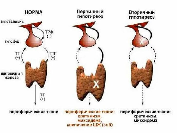 Врожденный первичный гипотиреоз. Первичные и вторичные заболевания щитовидной железы. Первичный вторичный третичный гипотиреоз. Классификация гипофункции щитовидной железы. Типы гипотиреоза
