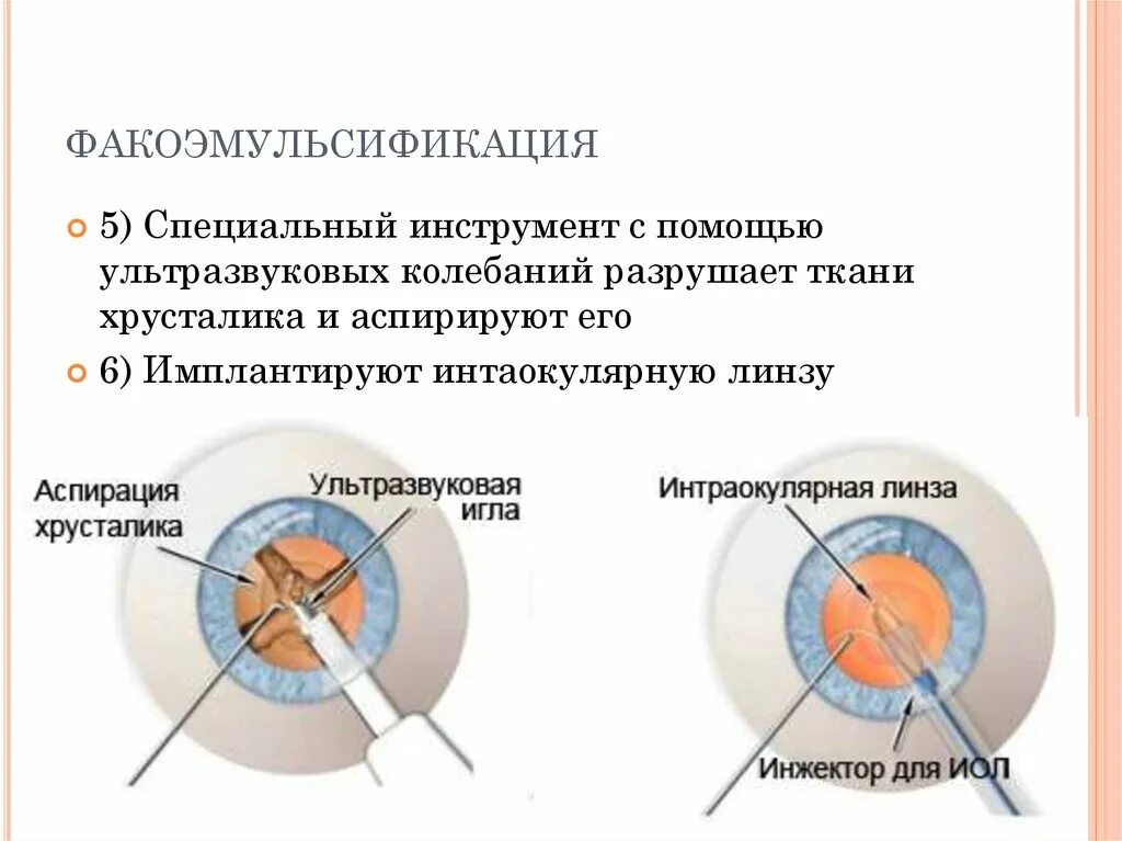 Катаракта факоэмульсификация. Операция ультразвуковая факоэмульсификация катаракты. Интраоперационные осложнения факоэмульсификация. Факоэмульсификация с имплантацией интраокулярной линзы.