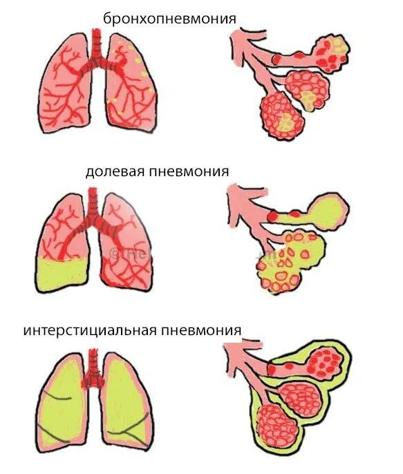 Чем грозит пневмония. Пневмония орган поражения. Двухсторонняя пневмония бронхиальная. Легкие поражение пневмонией. Пневмония поражаемые органы.