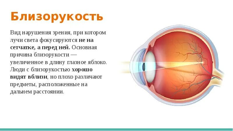 Нарушение зрения вызывает. Таблица заболевания глаз близорукость и дальнозоркость. Близорукость и дальнозоркость таблица по биологии. Причины нарушения зрения близорукость дальнозоркость. Причины развития близорукости и дальнозоркости.
