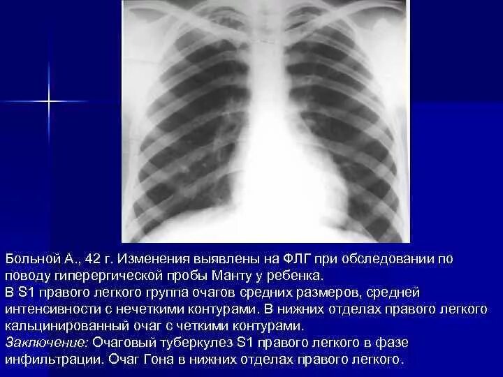 Первичный туберкулез правого легкого. Очаг гона на рентгенограмме. Первичный туберкулезный комплекс верхней доли правого легкого. Очаг гона в легких на рентгене. Изменения в верхней доле легкого