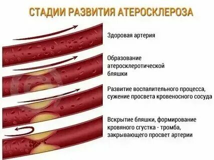 Стенозирующее образование. Стенозирующее образование