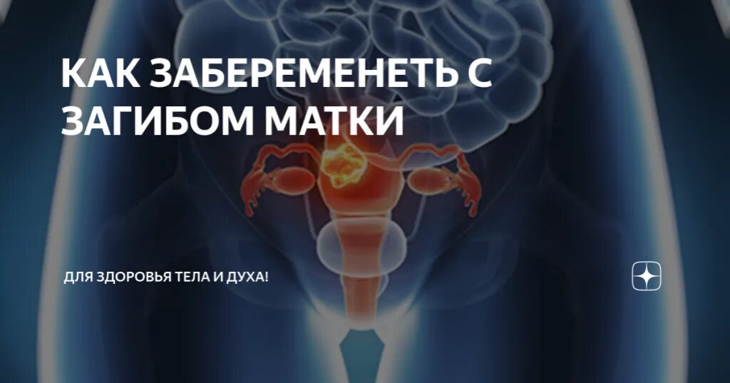 Можно ли забеременеть при загибе матки. Забеременеть с загибом матки. загиб матки и беременность. как забеременеть при загибе матки.