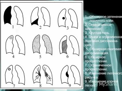 Рентген синдромы