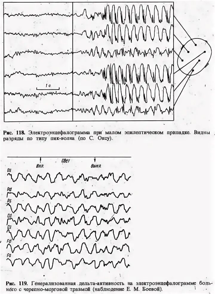 Эпилептиформная активность на ээг у ребенка. Эпилептиформные паттерны на ЭЭГ. Эпилептиформная активность на ЭЭГ. Иктальный паттерн на ЭЭГ. Пик полипик волна на ЭЭГ.