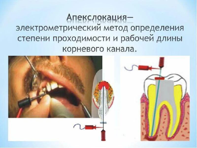 Определение корневых каналов. Методы определения рабочей длины корневого канала зуба. Электрометрический метод определения рабочей длины. Метод определения рабочей длины корневого канала. Электрометрический метод определения длины корневого канала.