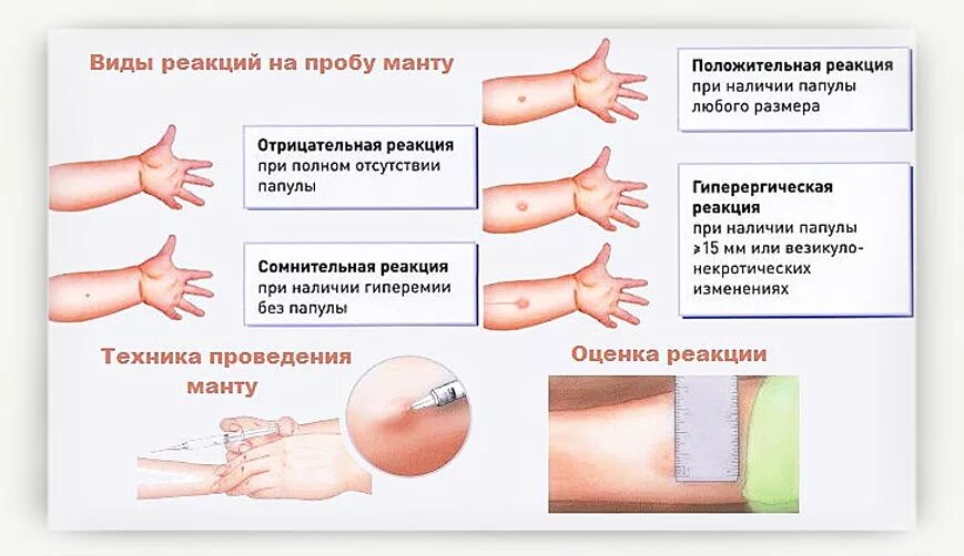 Норма кожи у детей. Реакция на манту норма у ребенка в годик. прививка манту размеры норма у детей в 2. реакция на пробу манту норма. виды реакций на пробу манту.