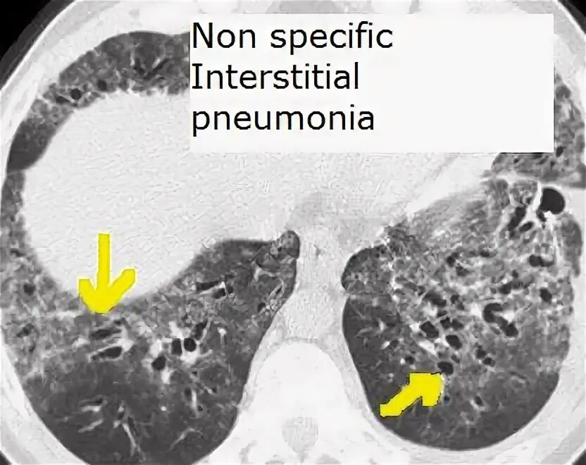 Non specific view. Non specific interstitial pneumonia. interstitial pneumonia ct.