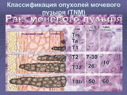 Прогноз рака мочевого