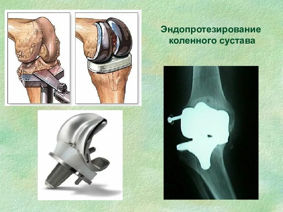 Эндопротезирование коленного сустава время операции. Эндопротезирование суставов. эндопротезирование коленного. эндопротезирование коленного сустава. эндопротезирование колена.