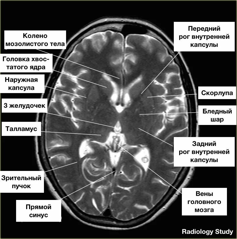 Базальные ядра головного мозга кт. Мозолистое тело на кт анатомия. Базальные ядра головного мозга анатомия кт. Базальные ганглии анатомия мрт. Очаговые изменения желудочка