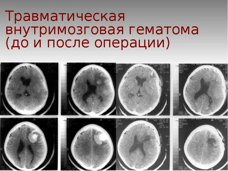 Травматических повреждений мозга. Гематома после операции. Внутримозговая гематома. Внутримозговая гематома послеоперационная.