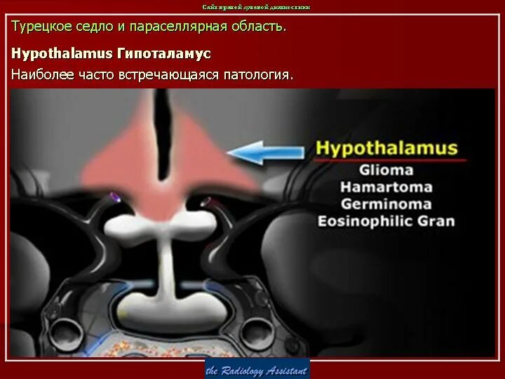 Образование турецкого седла. Селлярная и параселлярная область. Область турецкого седла. Параселлярная область на кт. Патология селлярной области.