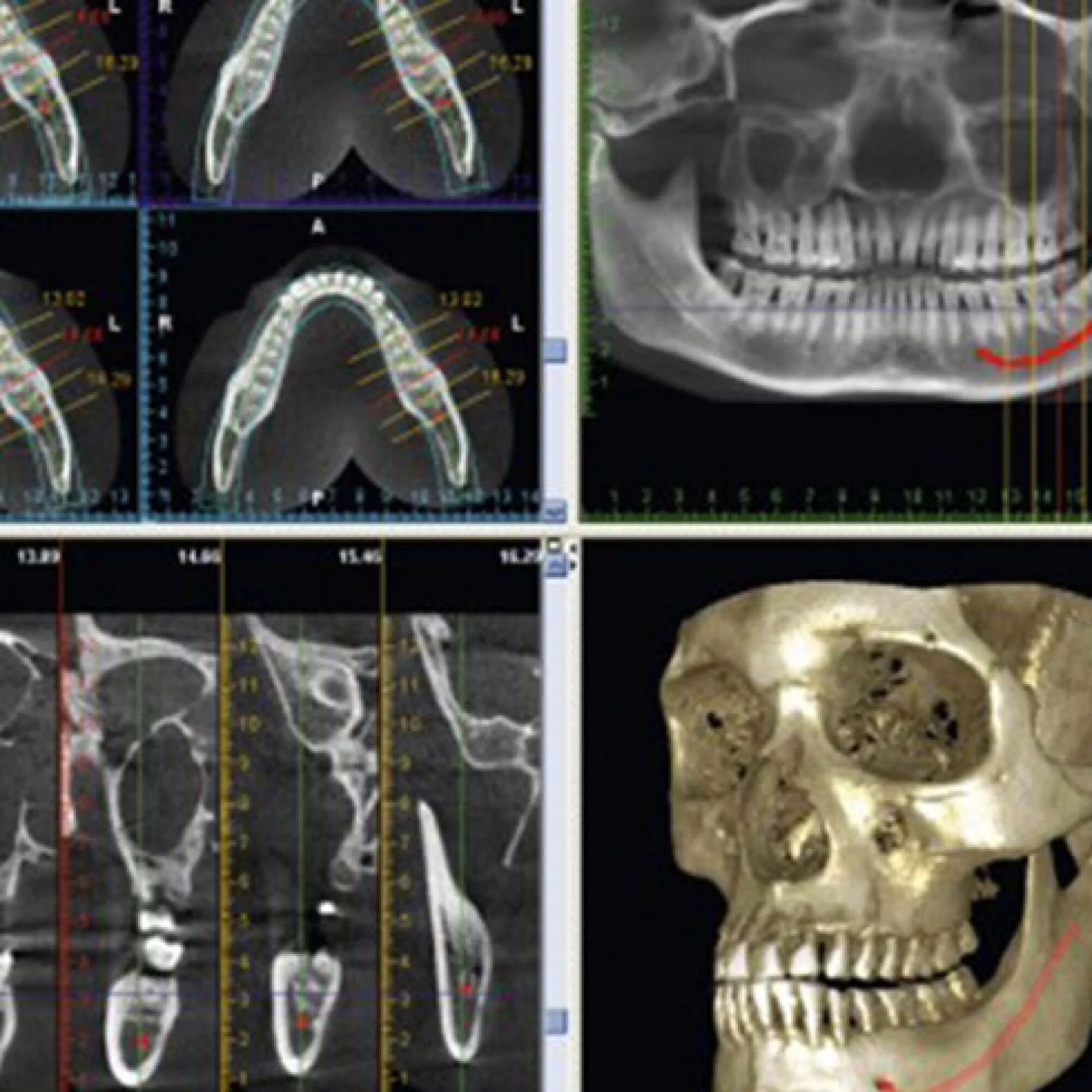 Имплант и мрт можно ли. Компьютерная томография 3д челюстей. Кт 15х15 верхней и нижней челюсти. Кт верхней и нижней челюсти 3д это. Снимок кт челюсти планмека.