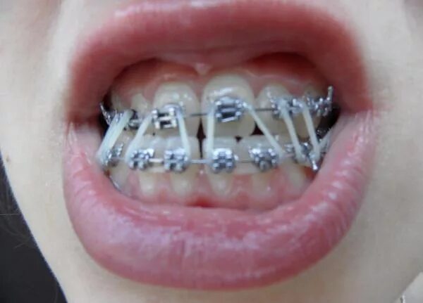 можно исправить мезиальный прикус. мезиальный прикус прикус. дистальный и мезиальный прикус. выпирающая нижняя челюсть. прогенический прикус до и после.