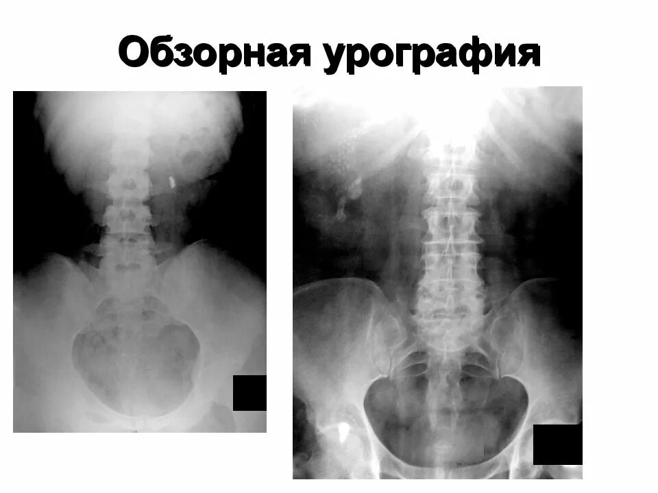 Обзорная рентгенография почек урография. Обзорная и экскреторная урография. Обзорная урография это. Обзорная урография это. Обзорная урография это.